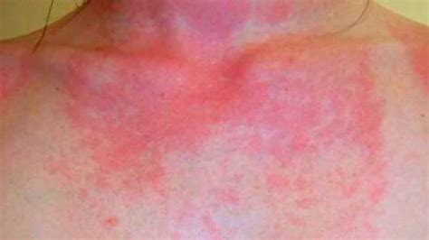 What Does Sun Allergy Rash Look Like? See These Pictures