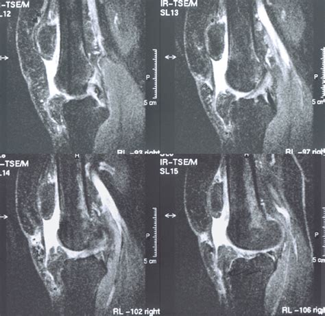 Multiple sagittal MRI views showing the complete patellar tendon... | Download Scientific Diagram