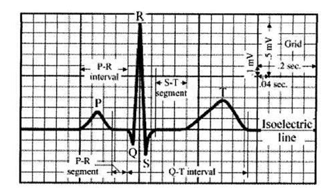 Normal Ecg Tracing