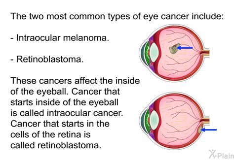 PatEdu.com : Eye Cancer