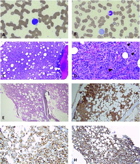 (A–B) Peripheral blood smear. (A) Acute megakaryoblastic leukemia ...