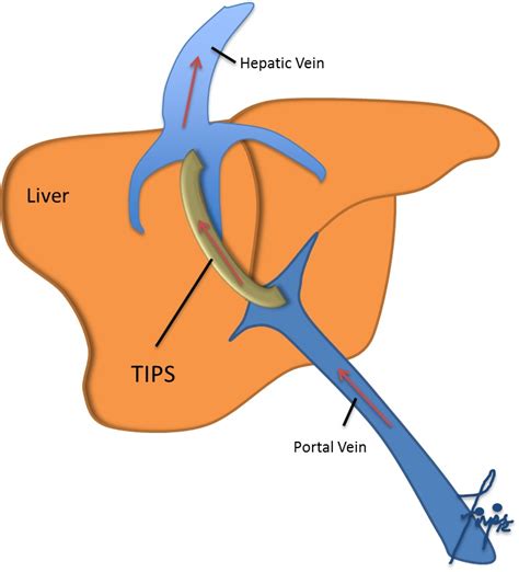 TIPS (Shunt): Transjugular Intrahepatic Portosystemic Shunt (TIPS) » TIPS (Shunt) » Division of ...