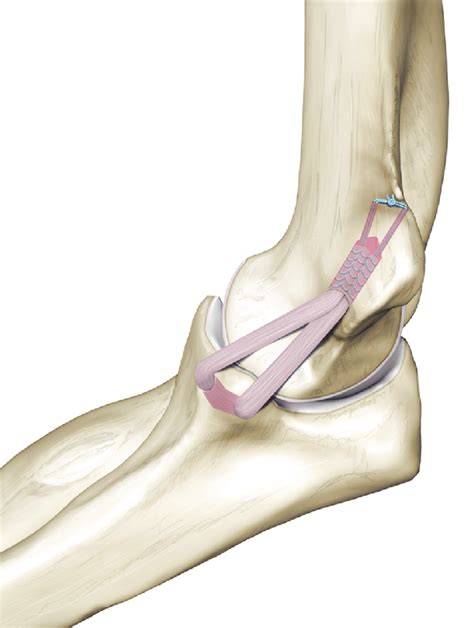 Docking technique for ulnar collateral ligament reconstruction. Figure ...