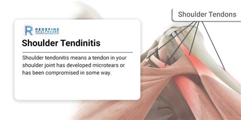 Shoulder Tendinitis - NJ's Top Orthopedic Spine & Pain Management Center