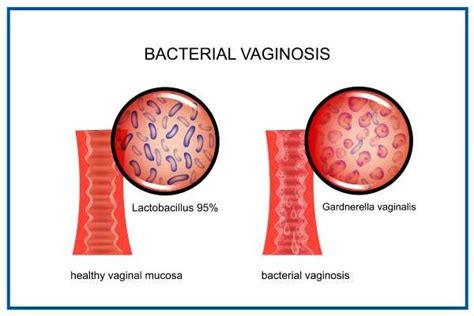 Natural Ways to Treat Bacterial Vaginosis – Mind&Mom