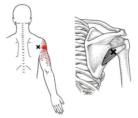 Teres Major Muscle Pain