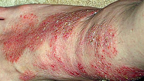 What Is Morgellons Disease?