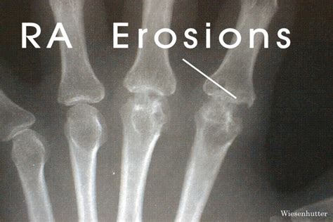 Rheumatoid Arthritis X Ray