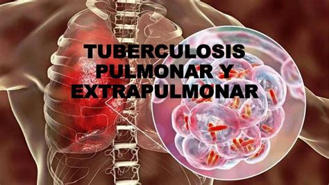 Tuberculosis pulmonar y extrapulmonar | Mishelle Chavez | uDocz