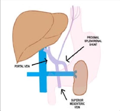 Surgery prototype of proximal splenorenal shunt. | Download Scientific ...