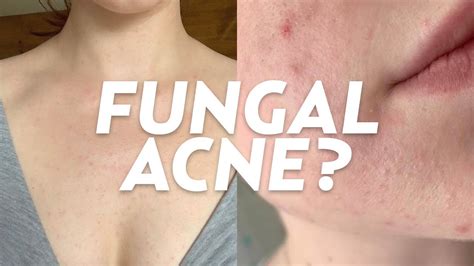 5 Tips on How To Treat Fungal Acne On Your Face Effectively