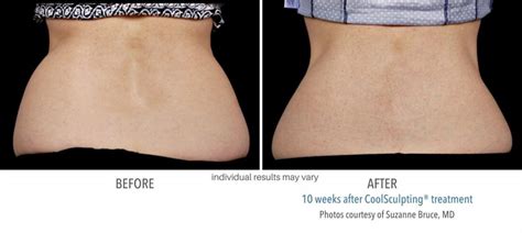 Philadelphia CoolSculpting®: Non-Invasive Body Sculpting