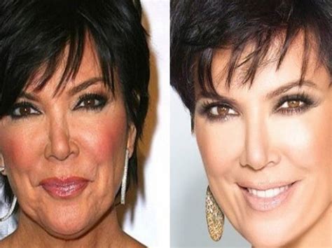 Kris Jenner’s Before and After Plastic Surgery Photos Show She Looks ...