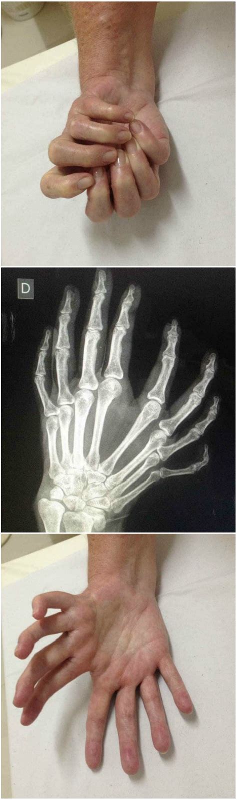 Is This a Real Hand With Eight Fingers? | Snopes.com