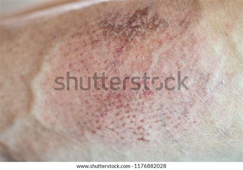 Skin Abrasion Scars Become Scarring Stock Photo 1176882028 | Shutterstock