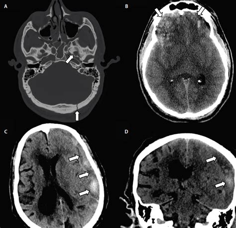 Traumatic Brain Injury Mri