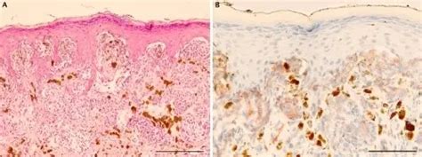 What is Spitz Nevus? - Pathosomes