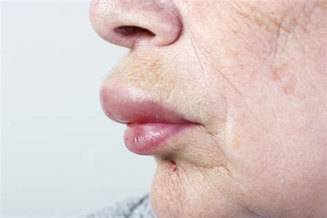 How To Reduce Swelling From Allergic Reaction - Ademploy19