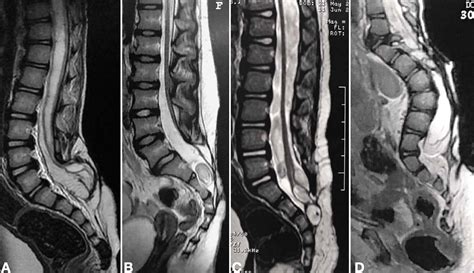 Cureus | Tethered Cord Syndrome After Myelomeningocele Repair: A ...