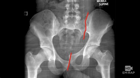 Pelvic Fracture X Ray