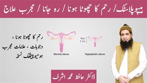 Hypoplastic/ subinvolution/ small uterus / Homeopathic treatment by dr m ashraf - YouTube