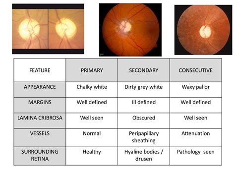 Approach to a pale optic disc