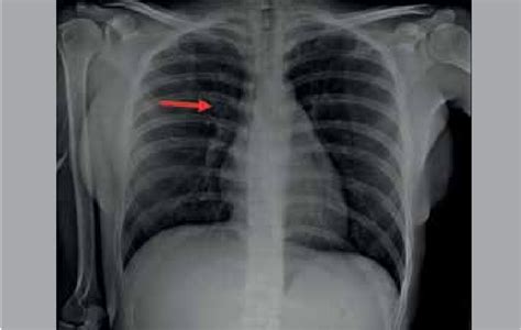 Chest x-ray showing the tip of the PICC positioned in the superior vena... | Download Scientific ...