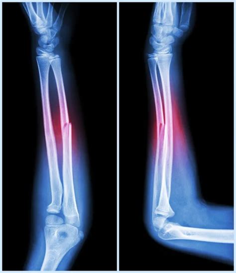 Fracture shaft of ulnar bone ( forearm bone ) : ( front and side view )