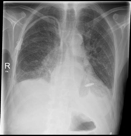 Leadless cardiac pacemaker | Radiology Reference Article | Radiopaedia.org