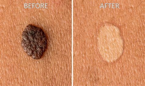 How to get rid of moles: 9 natural home remedies to remove moles from your body | Lifestyle News ...