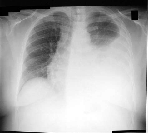 Pleural Fluid - Urinalysis and Body Fluids