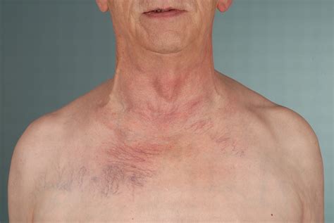 A man with dilated veins on his upper chest | The BMJ