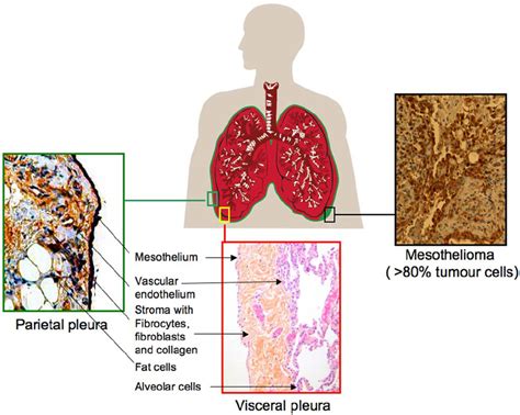 Schematic presentation of mesothelioma, the parietal and visceral... | Download Scientific Diagram