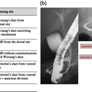 (a) Yogi et al. described six types of annular pancreas according to... | Download Scientific ...