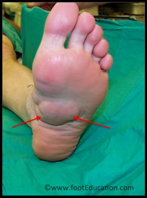 Plantar Fibroma - FootEducation