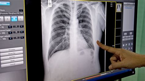 Healthy Lungs Vs Smokers Lungs X Ray