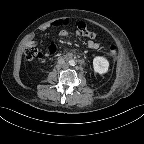 Para Aortic Lymphadenopathy Differential Diagnosis