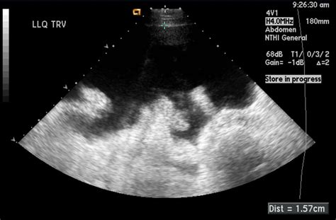 Ascites ultrasound - wikidoc