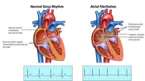 Atrial Fibrillation - Melbourne Heart Group