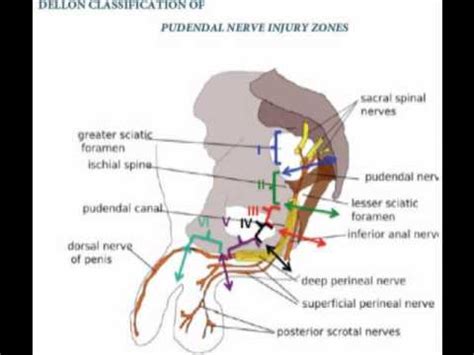 What are Pudendal Neuralgia and Pudendal Nerve Entrapment Causes ...