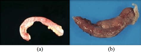 (a) Normal appendix, (b) Appendix inflammation | Download Scientific Diagram