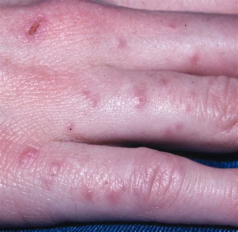 scabies on hands - pictures, photos