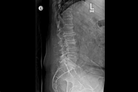 Case Study: Chronic Lower Back Pain and an Incidental Abdominal Aortic Aneurysm - Clinical Pain ...