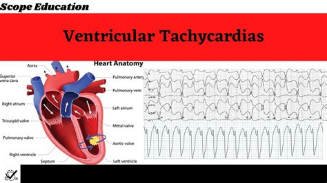 Identifying the Different Types of Ventricular Tachycardias - YouTube