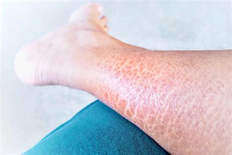 Ichthyosis Vulgaris: Causes, Symptoms, and Treatment