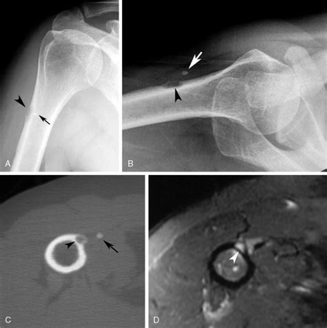 Hydroxyapatite Deposition Disease | Musculoskeletal Key