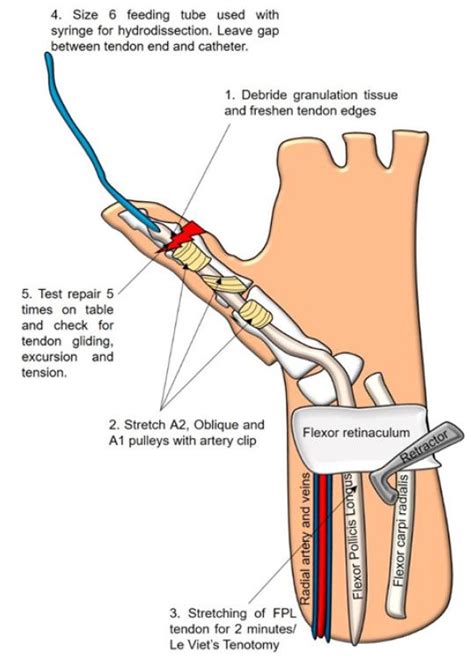 Tips and tricks for getting more out of your delayed primary repair of ruptured flexor pollicis ...