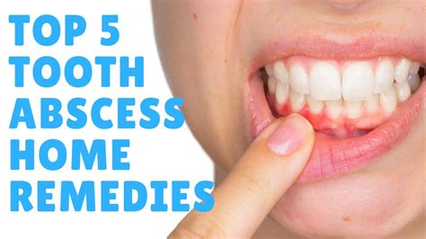 Tooth Abscess: Top 5 Tooth Abscess Home Remedies & Treatments - GET FAST RELIEF - Dental Clinic