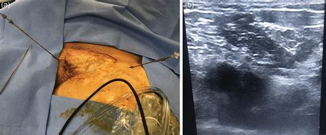 Complications of Lateral Obturator and Lateral Femoral Nerve Block and Radiofrequency Ablation ...