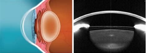 Posterior Chamber Phakic Intraocular Lens: Indications, Contraindications, Technique, and ...